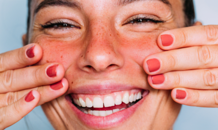 Rosacea vs. Acne: A dermatologist explains the differences