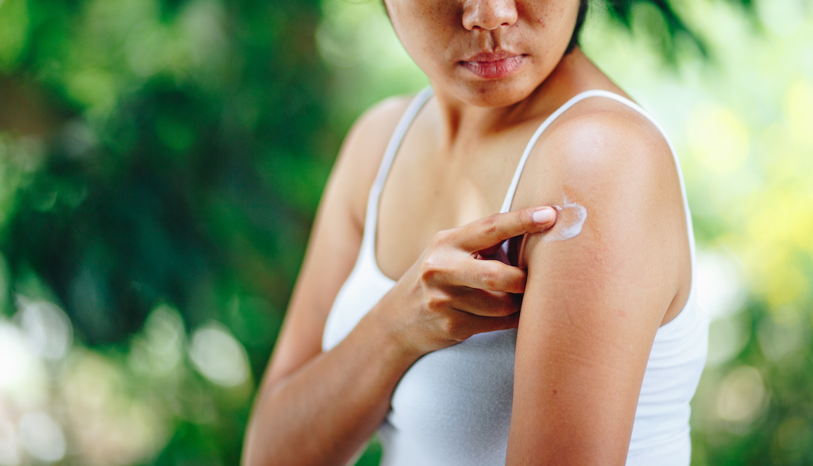 6 Home Remedies for Bug Bites Dermatologists Recommend